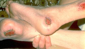 bed-sores