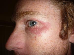 seborrheic-dermatitis-eyes