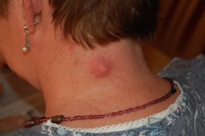 Inflamed_epidermal_inclusion_cyst