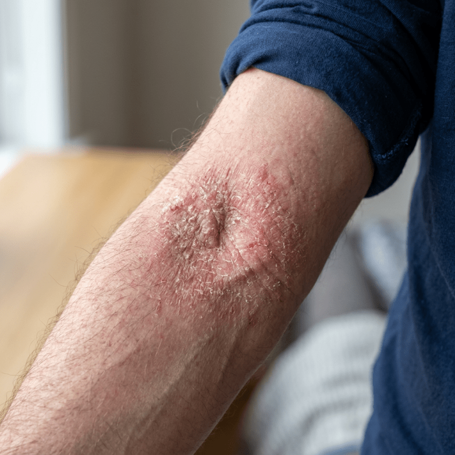 Dry, red, cracked skin surrounding a person's elbow
