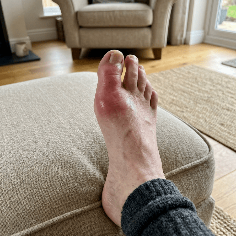 Swollen, reddened big toe resting on a beige ottoman