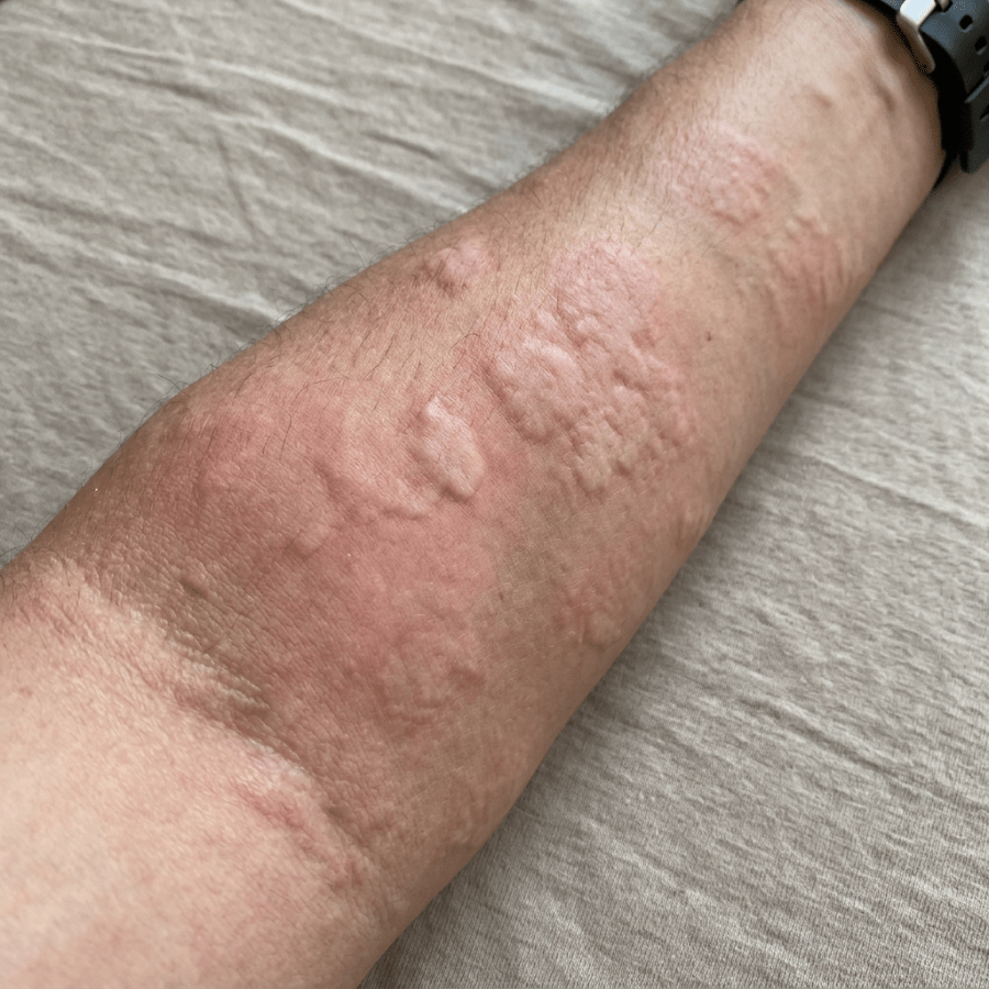 Raised pink welts covering a person’s forearm