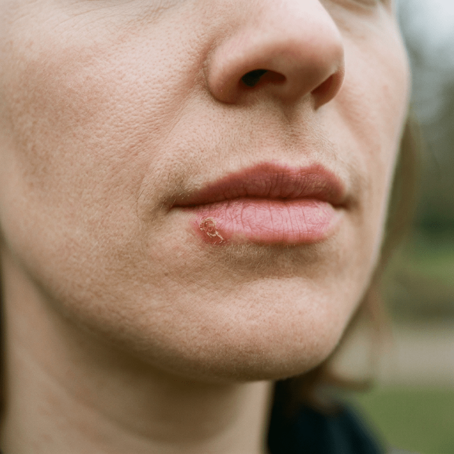 Close-up of a small cold sore on a person's lower lip