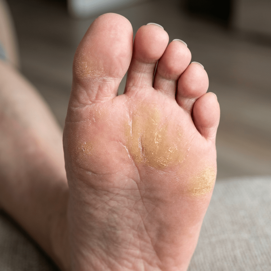 Sole of foot with dry, peeling skin and calluses