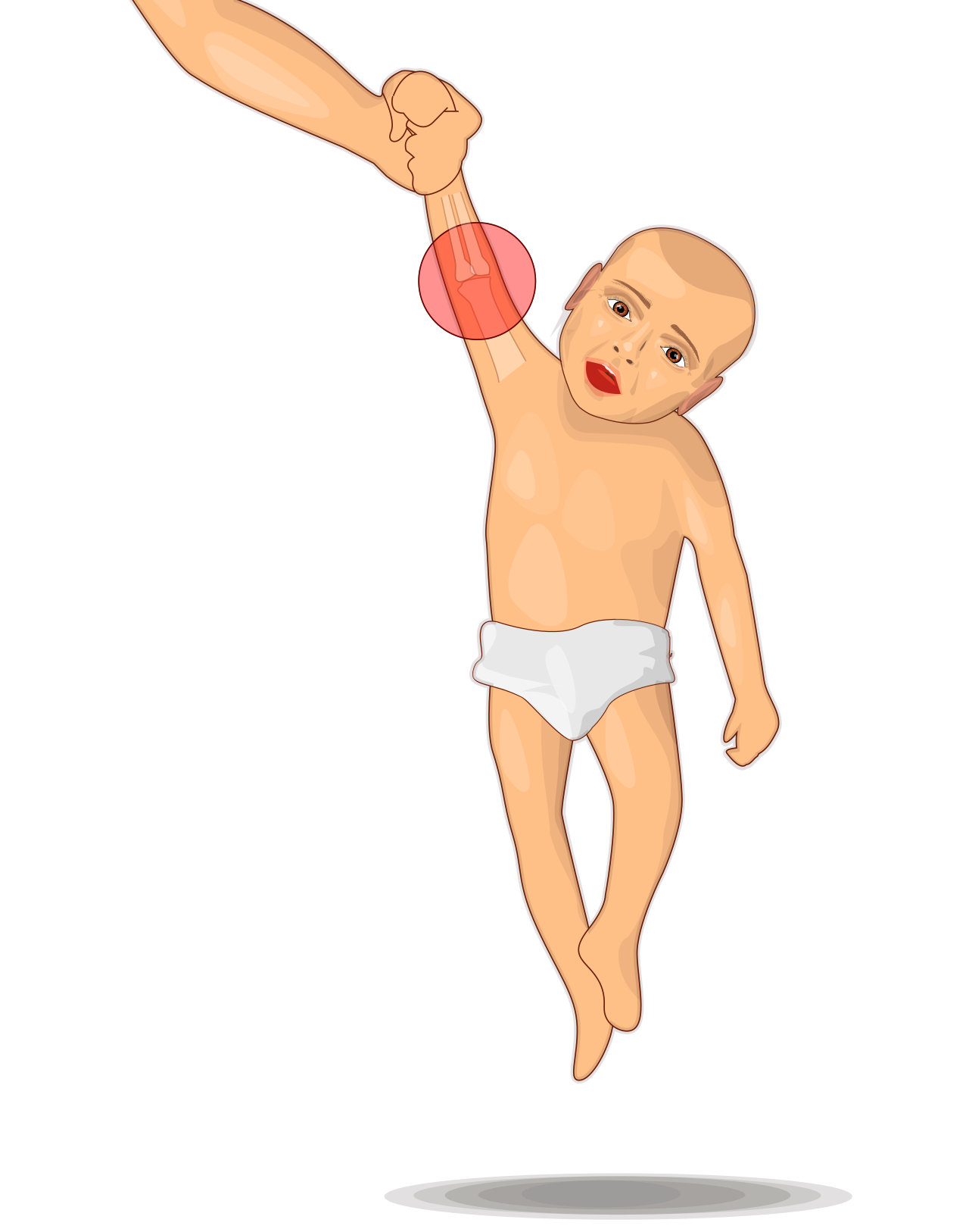 Illustration of a toddler being pulled upward by the forearm with the elbow highlighted, the typical mechanism of radial head subluxation